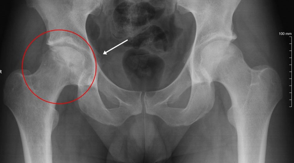 Zwyrodnienie Stawu Biodrowego Zwyrodnienie Biodra Objawy Przyczyny