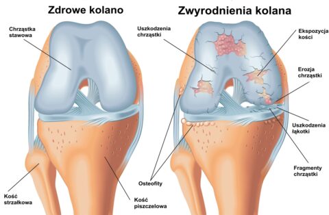 Zwyrodnienie Kolana Stawu Kolanowego Objawy Przyczyny Operacja