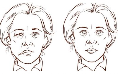 Porażenie twarzy (niedowład twarzy) w chorobie neurologicznej