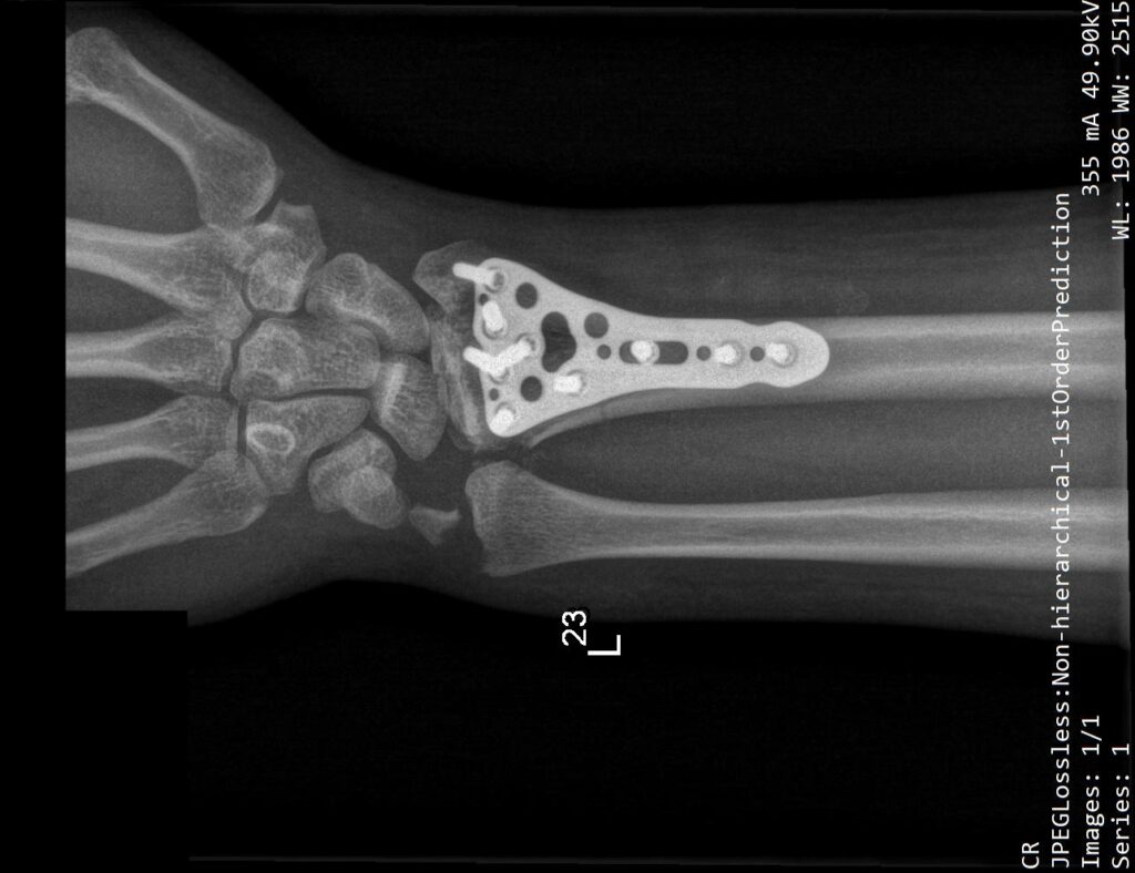 Złamanie nasady dalszej kości promieniowej (w nadgarstku) – z - Przy Złamaniu Kości Przedramienia Należy