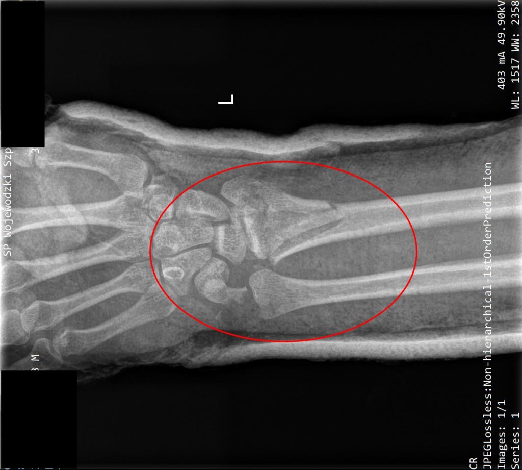 Złamanie nasady dalszej kości promieniowej (w nadgarstku) – z - Przy Złamaniu Kości Przedramienia Należy