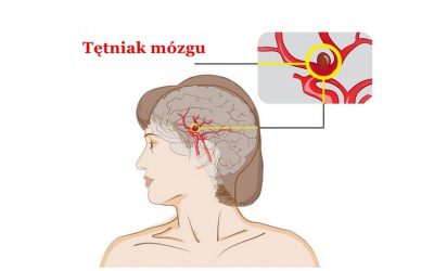Tętniak mózgu – objawy, przyczyny, badania, leczenie