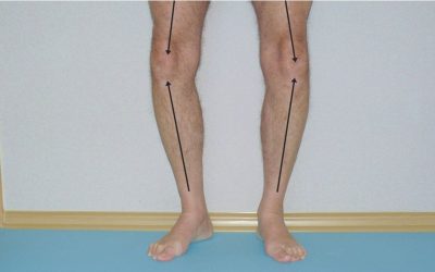 Szpotawe kolana (Szpotawość stawów kolanowych) – objawy, przyczyny, leczenie, rehabilitacja