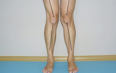 Koślawość stawów kolanowych, kolana koślawe – objawy, przyczyny, leczenie