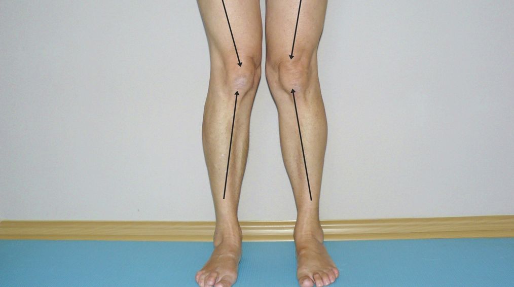Koślawość stawów kolanowych, kolana koślawe – objawy, przyczyny, leczenie