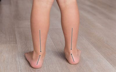 Koślawe stopy (Koślawość stóp, stopa płasko koślawa) – objawy, leczenie, rehabilitacja