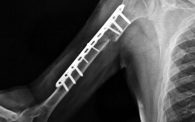 Złamanie kości ramiennej (nasady bliższej) – objawy, leczenie, rehabilitacja