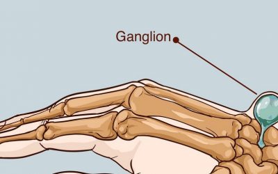 Torbiel nadgarstka (ganglion, na dłoni) – objawy, leczenie, operacja