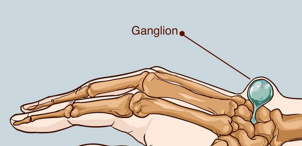 Torbiel nadgarstka (ganglion, na dłoni) – objawy, leczenie, operacja