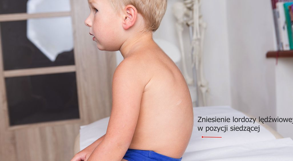 Zniesienie lordozy lędźwiowej u dzieci – objawy, przyczyny, leczenie, rehabilitacja