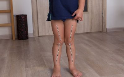 Koślawe kolana u dzieci (koślawość kolan) – objawy, leczenie, rehabilitacja