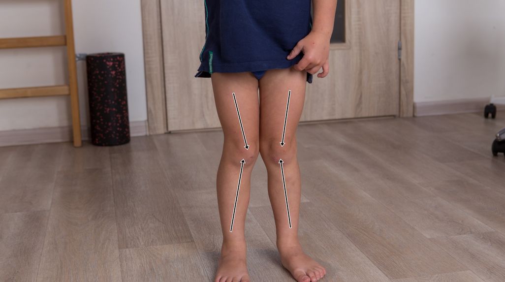 Koślawe kolana u dzieci (koślawość kolan) – objawy, leczenie, rehabilitacja
