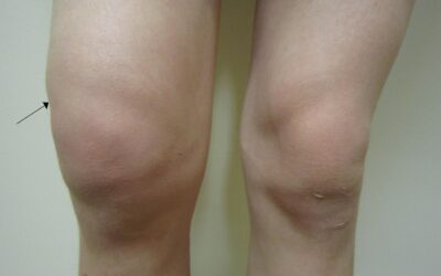 Obrzęk kolana (opuchlizna kolana, woda w kolanie) – przyczyny i leczenie