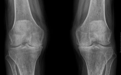 Ból kolana – jakie badania? Rtg, Rezonans (MR), Usg, Artroskopia